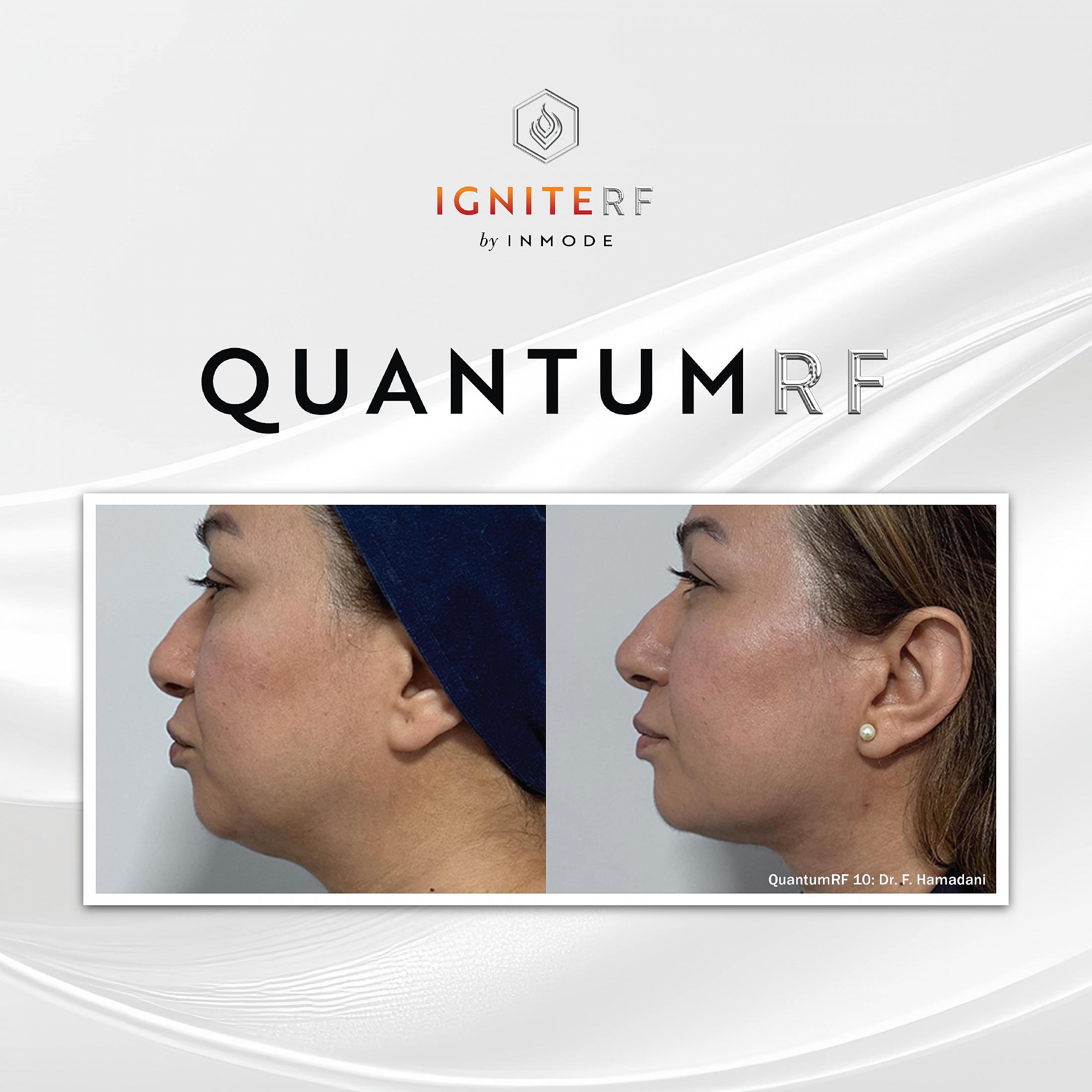 QuantamRF before and after