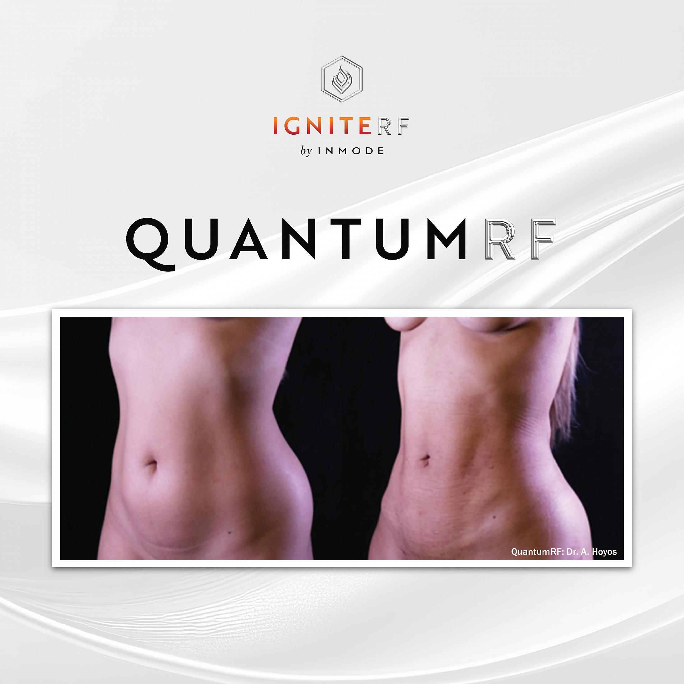 QuantamRF before and after
