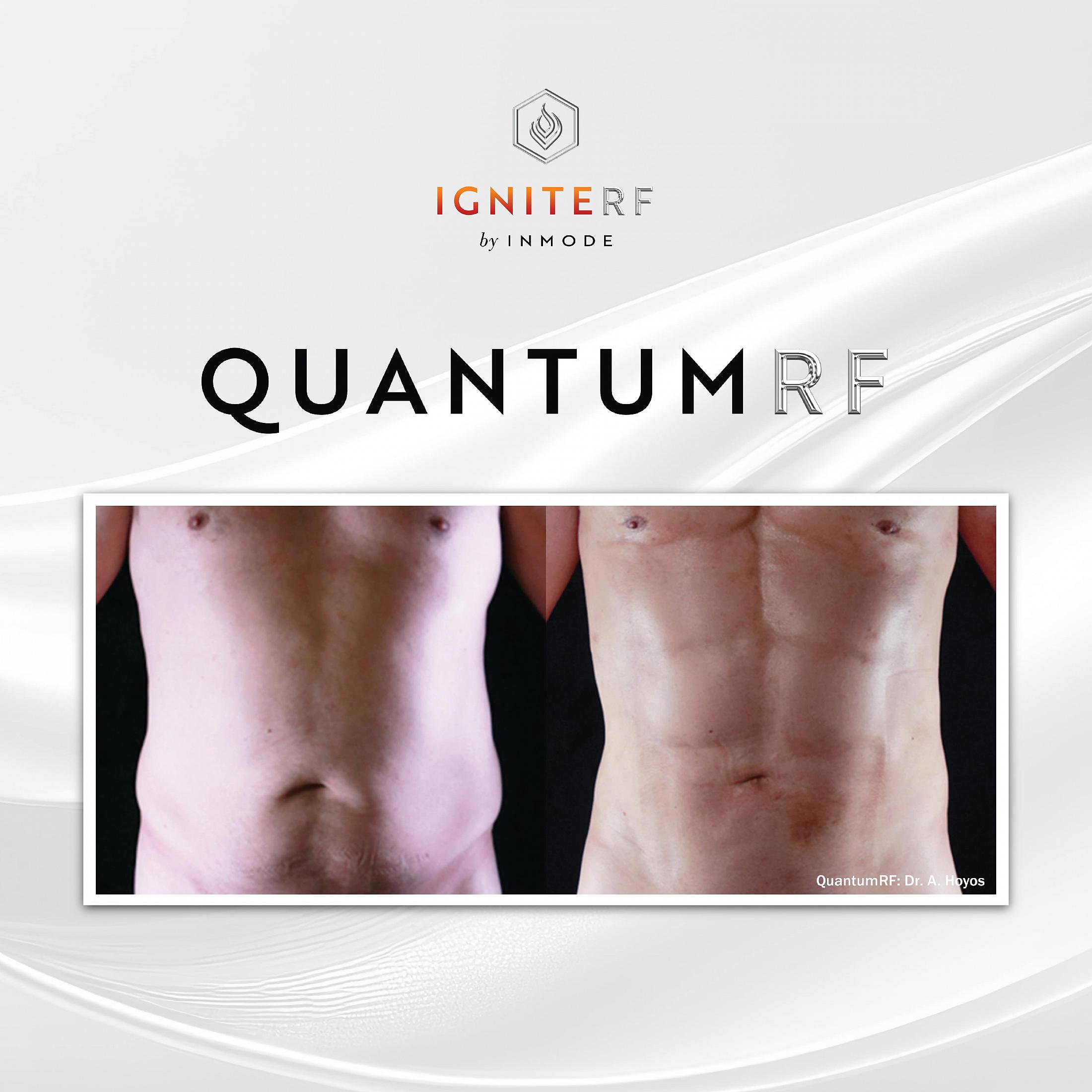 QuantamRF before and after
