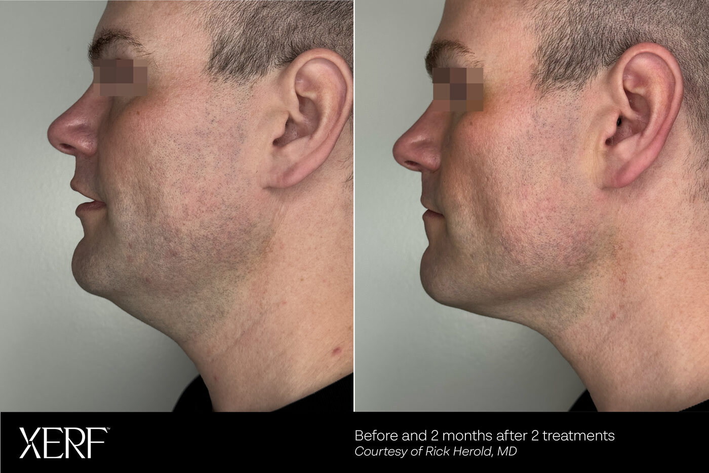 XERF RF before and after result two months after two treatments