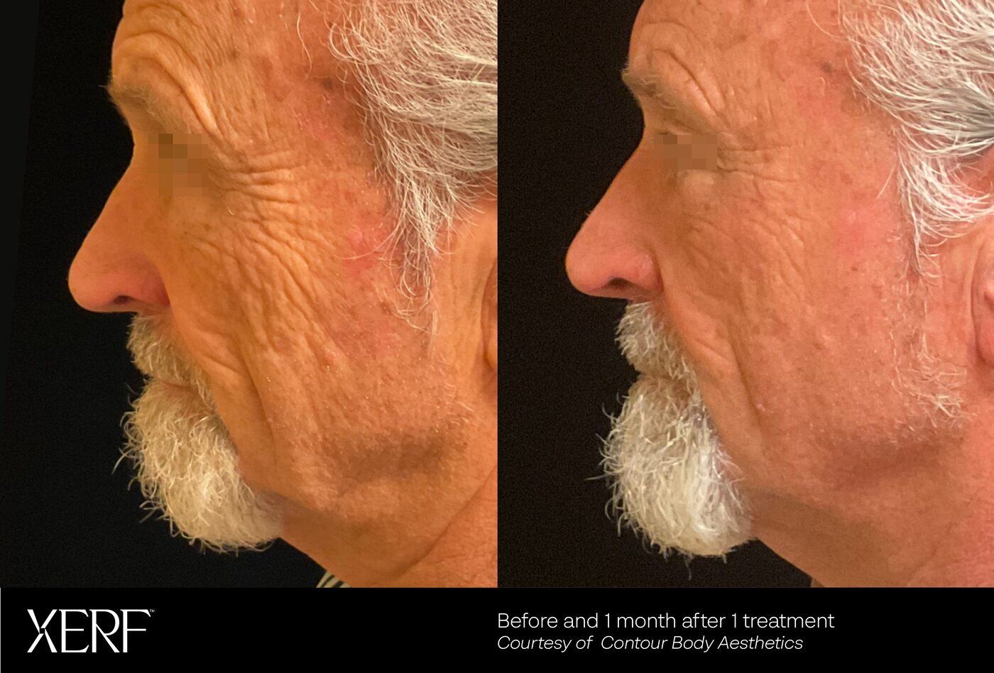 XERF RF before and after result one month after one treatment