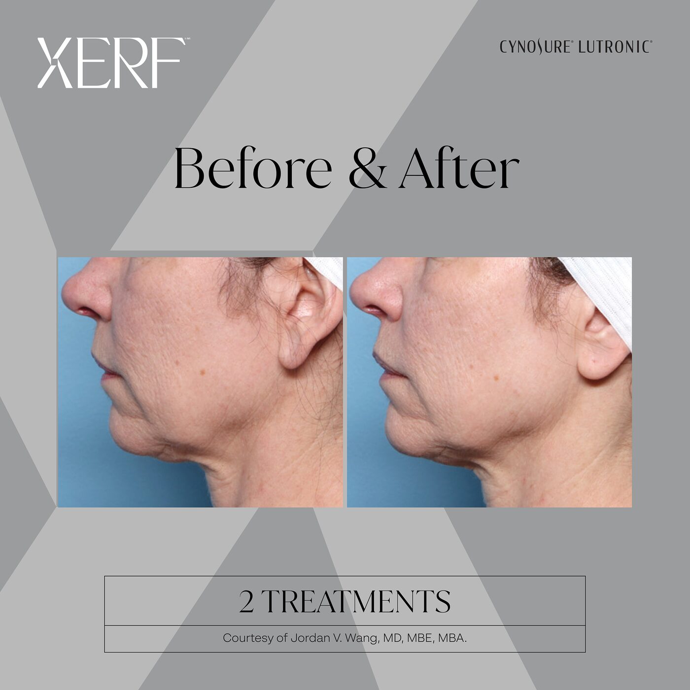 XERF RF before and after result after two treatments