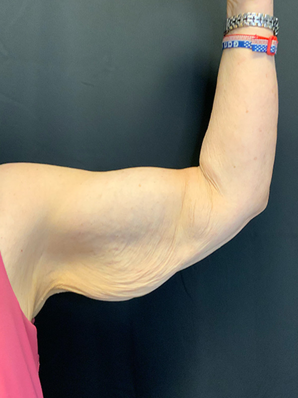 Arm Lift Before & After Image