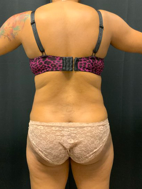 Brazilian Butt Lift Before & After Image