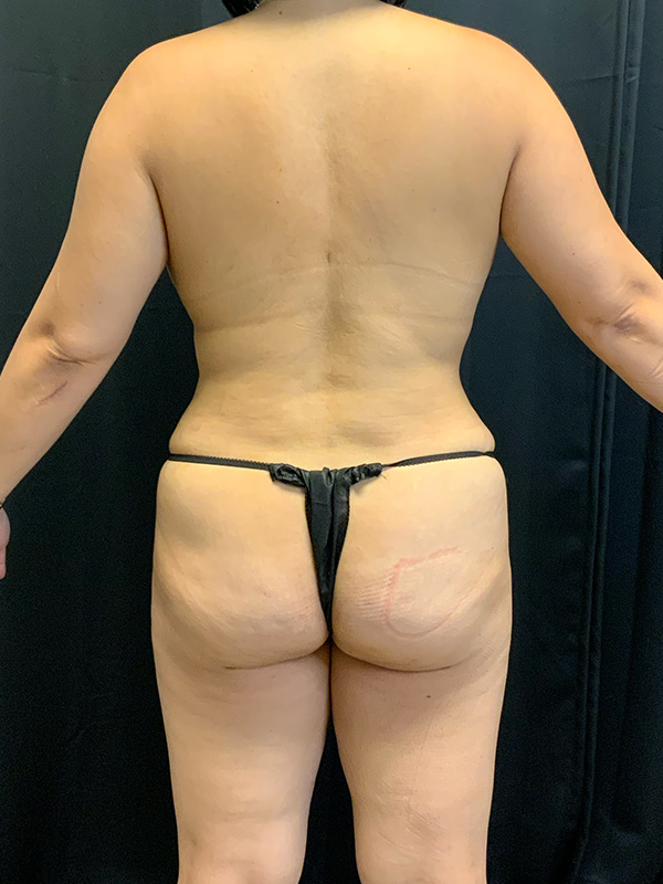 Brazilian Butt Lift Before & After Image