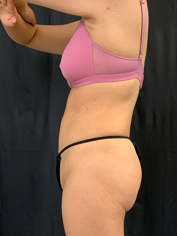 Brazilian Butt Lift Before & After Image