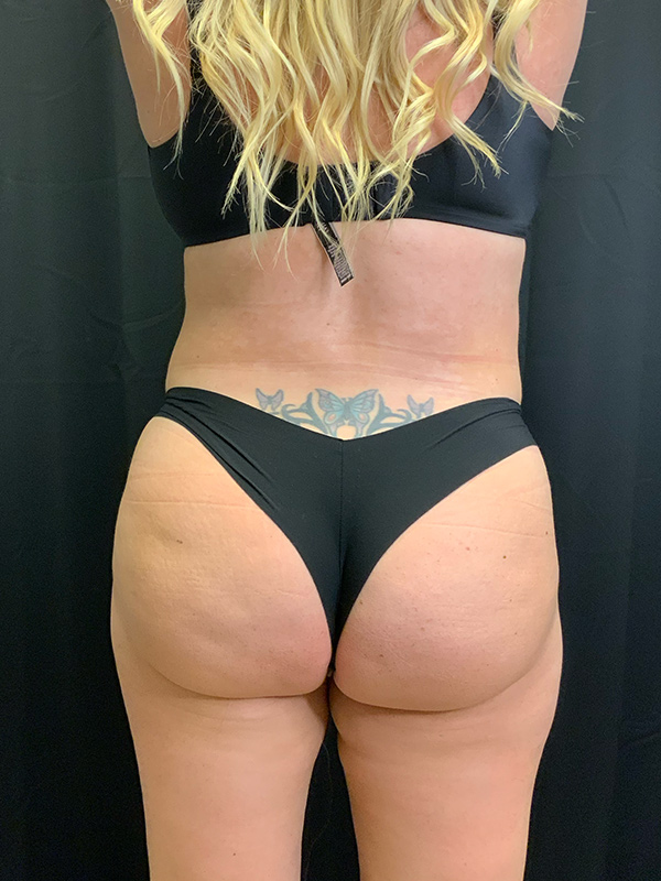 Brazilian Butt Lift Before & After Image