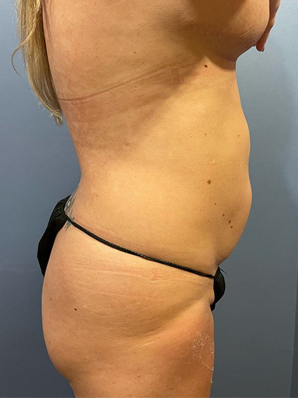 Brazilian Butt Lift Before & After Image