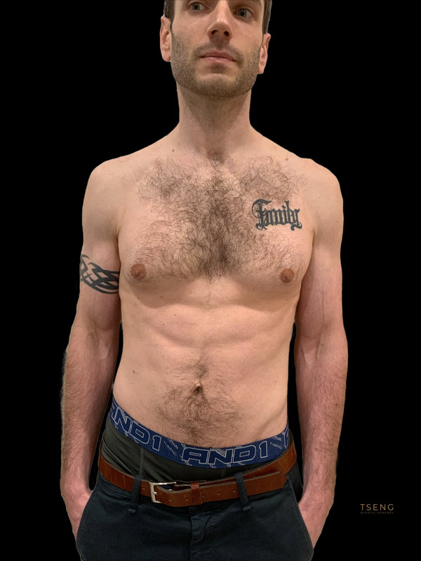 Gynecomastia Surgery Before & After Image