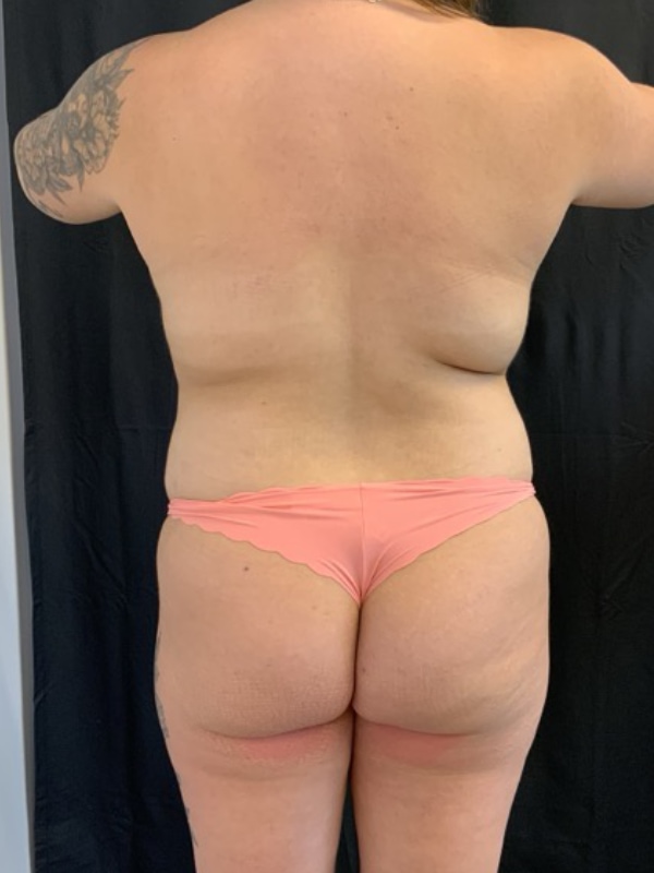 Lipo 360 Before & After Image