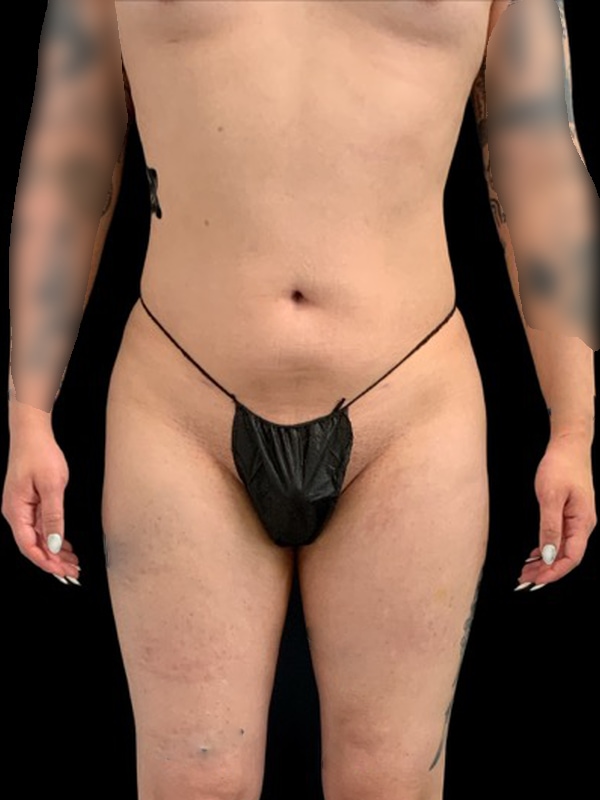 Lipo 360 Before & After Image