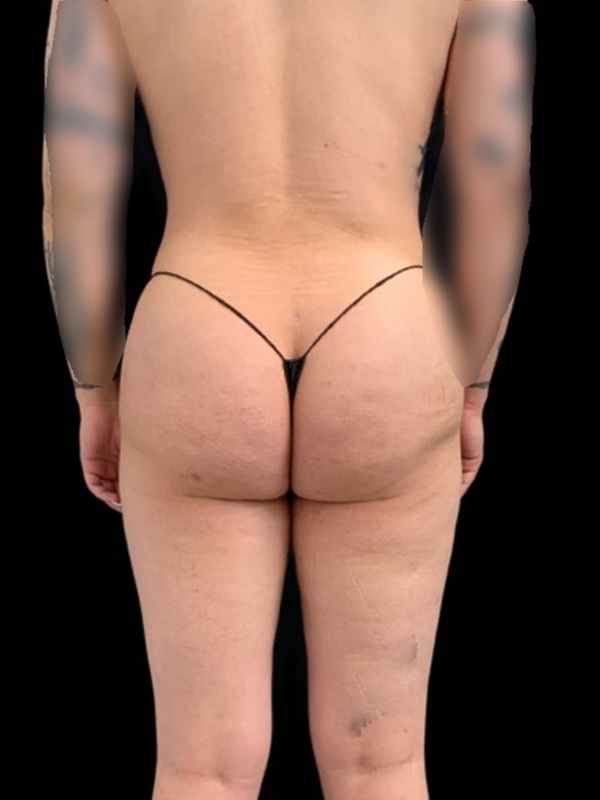 Lipo 360 Before & After Image
