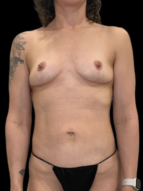 Mini Enhanced Abdominoplasty Before & After Image