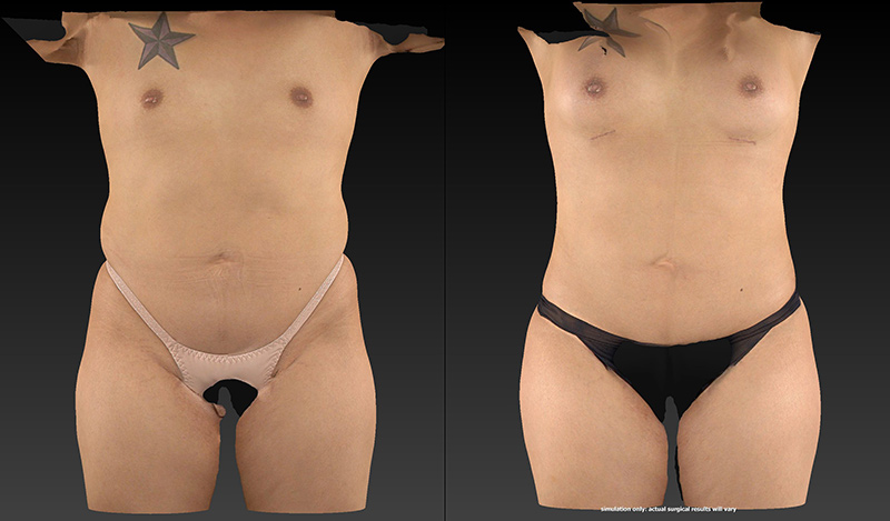 Body Lift Before & After Image