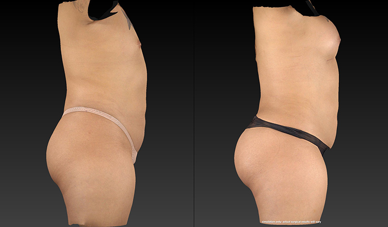 Body Lift Before & After Image