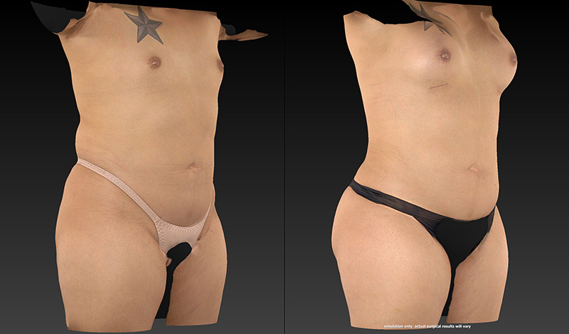 Body Lift Before & After Image