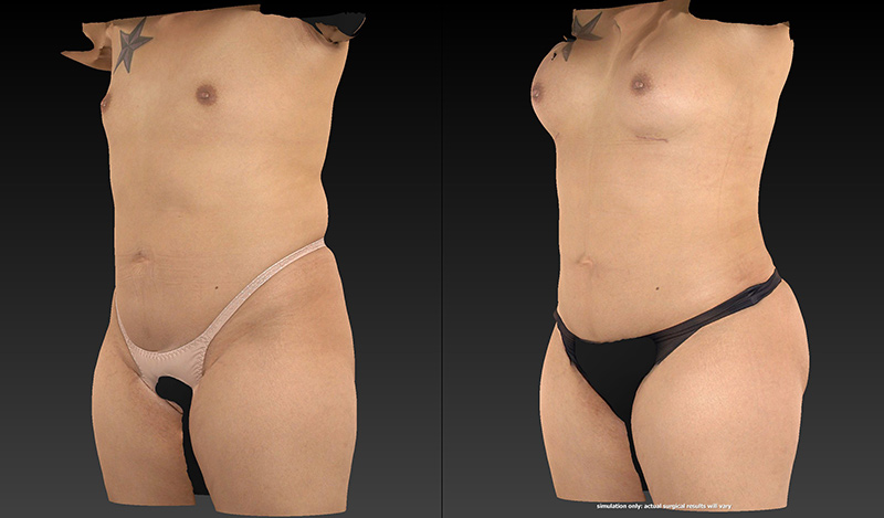 Body Lift Before & After Image