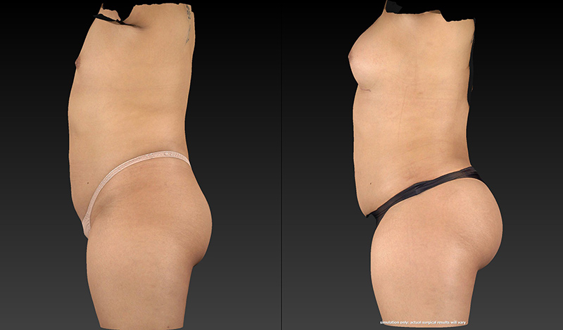 Body Lift Before & After Image