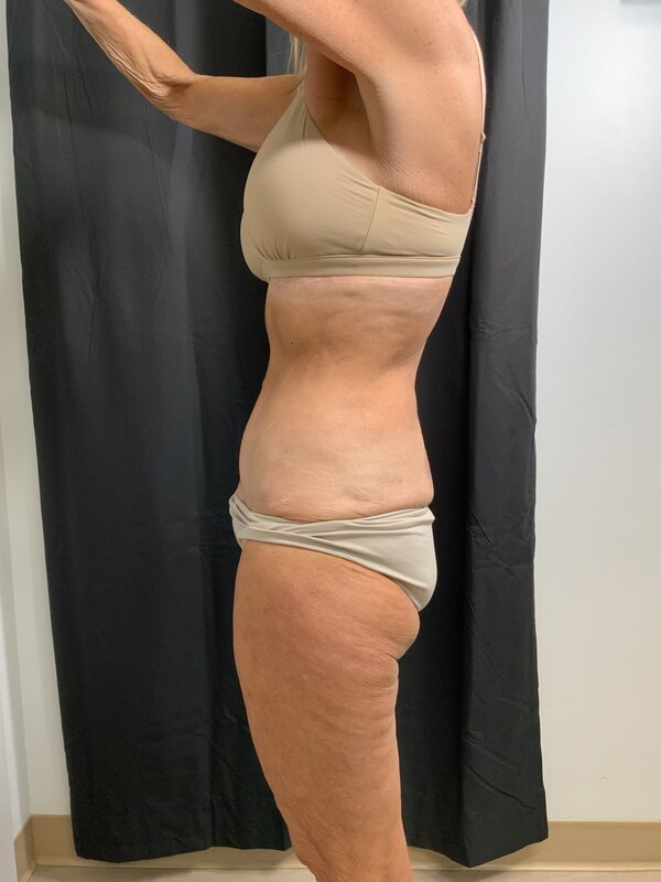 Tummy Tuck Before & After Image