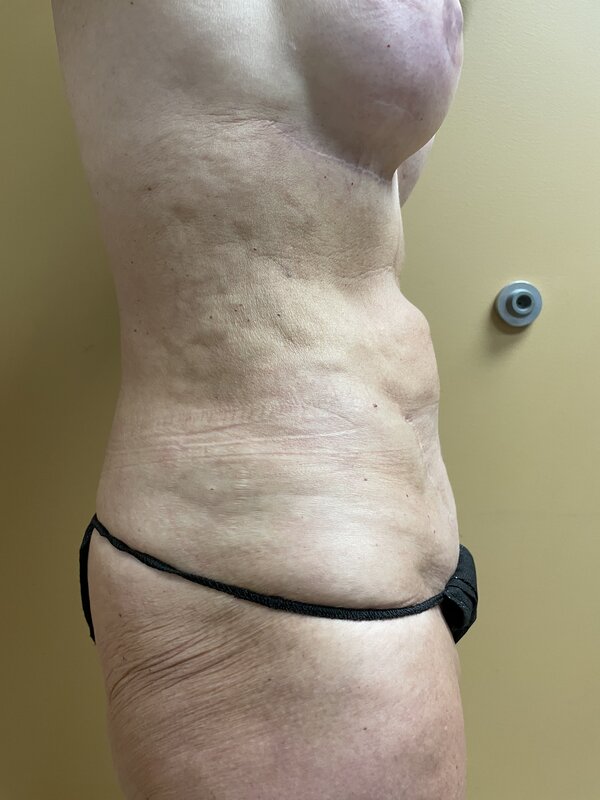 Tummy Tuck Before & After Image