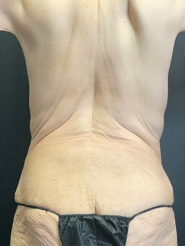 Tummy Tuck Before & After Image