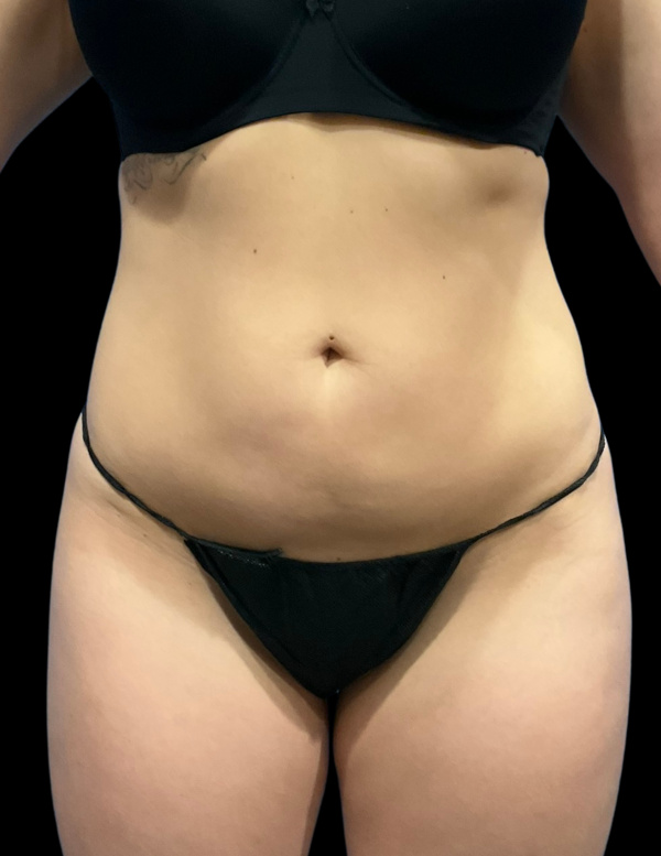 VASER HD Liposuction Before & After Image