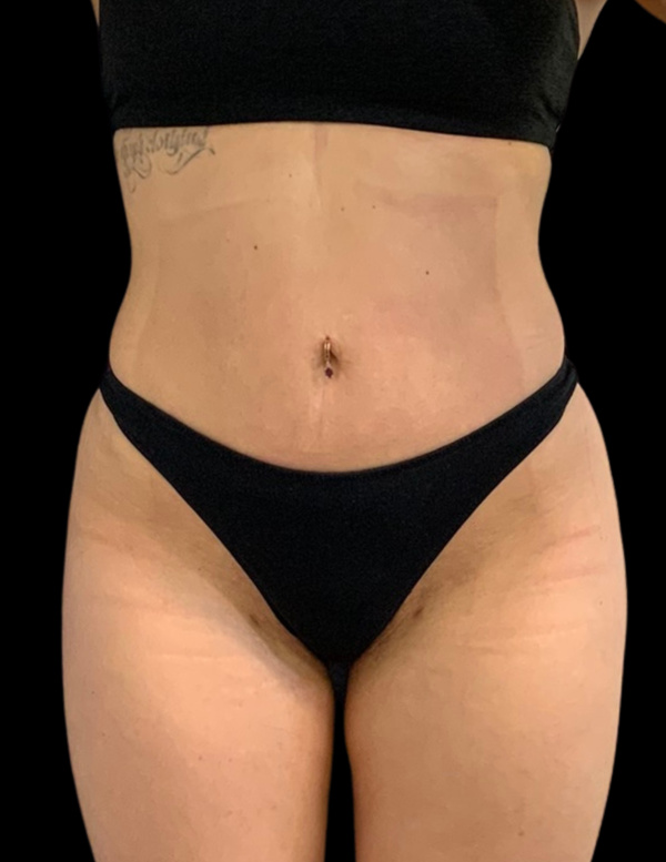 VASER HD Liposuction Before & After Image