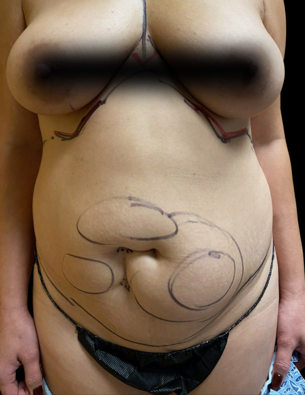 VASER HD Liposuction Before & After Image