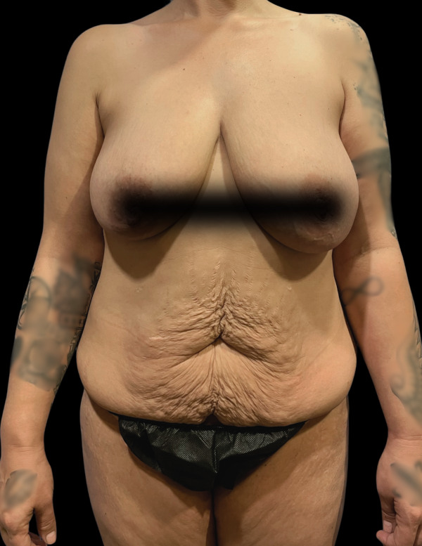VASER HD Liposuction Before & After Image