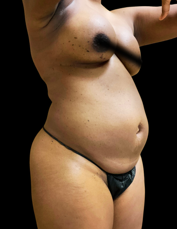 VASER HD Liposuction Before & After Image