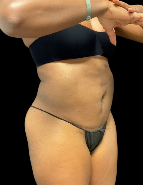 VASER HD Liposuction Before & After Image