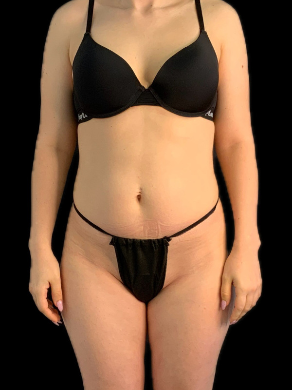 VASER HD Liposuction Before & After Image