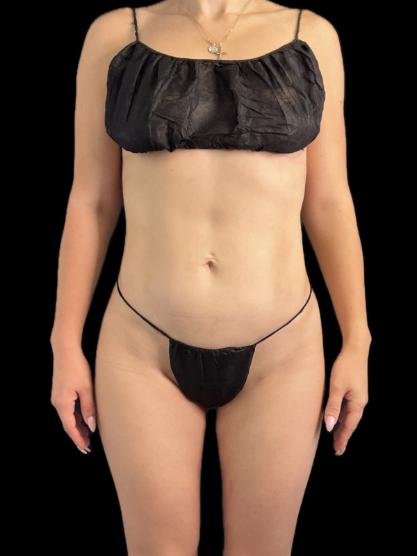 VASER HD Liposuction Before & After Image