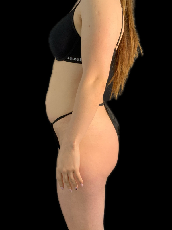 VASER HD Liposuction Before & After Image