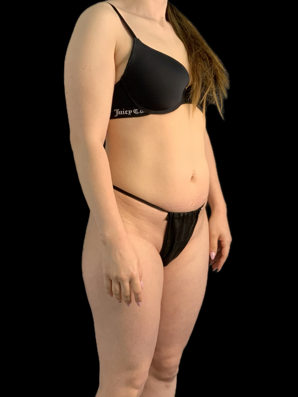 VASER HD Liposuction Before & After Image