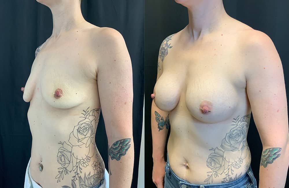 Breast Augmentations Before & After Image