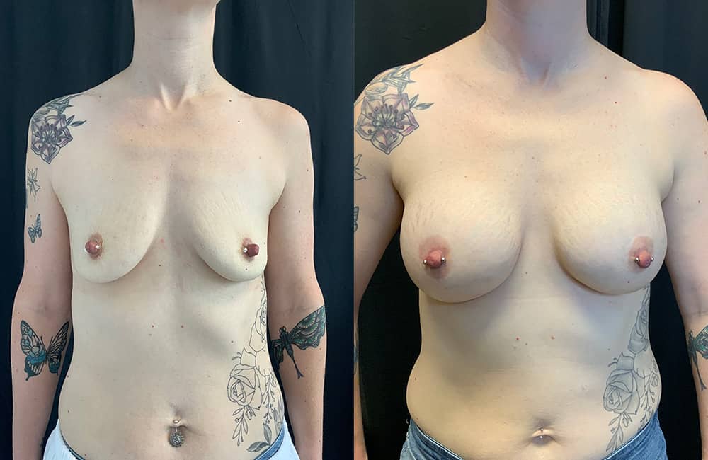 Breast Augmentations Before & After Image