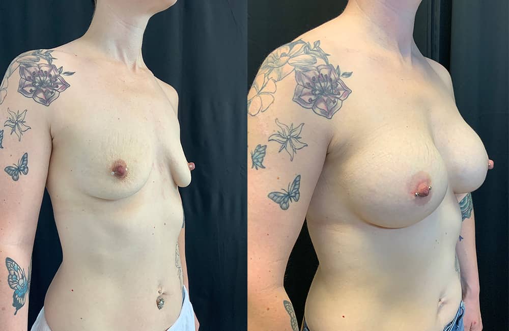 Breast Augmentations Before & After Image