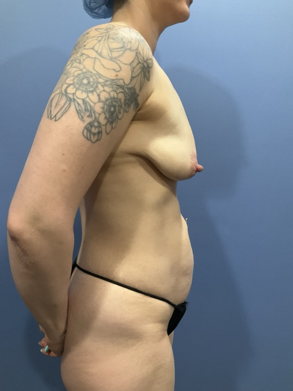 Breast Lift Mastopexy Before & After Image