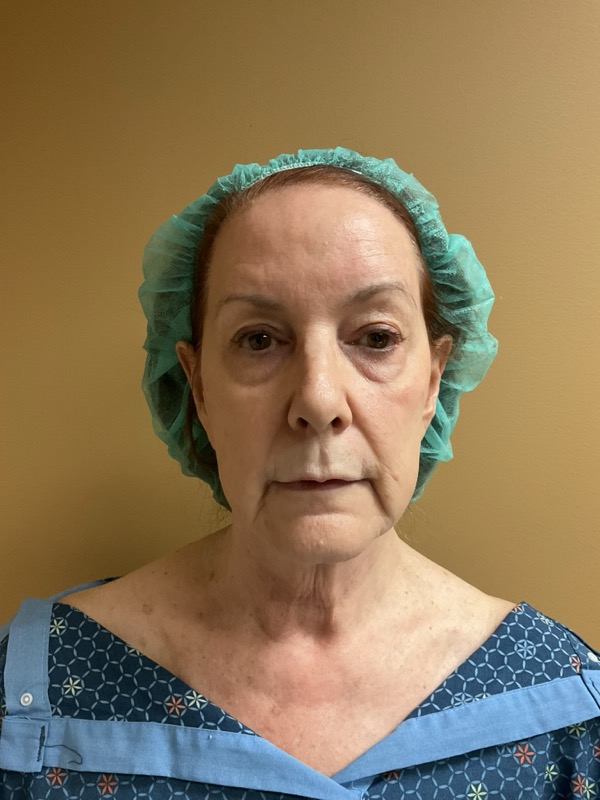 Brow lift Before & After Image