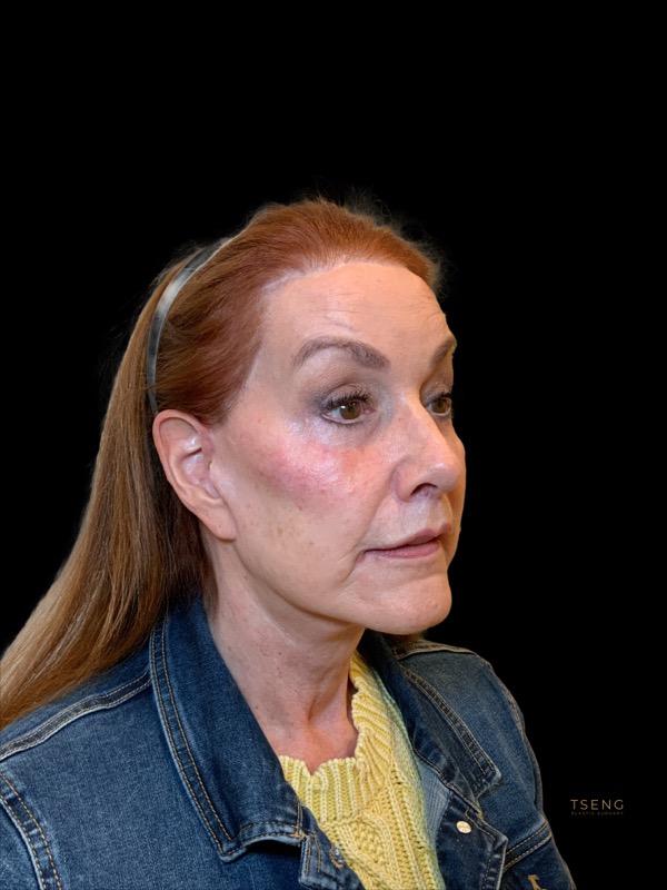 Brow lift Before & After Image