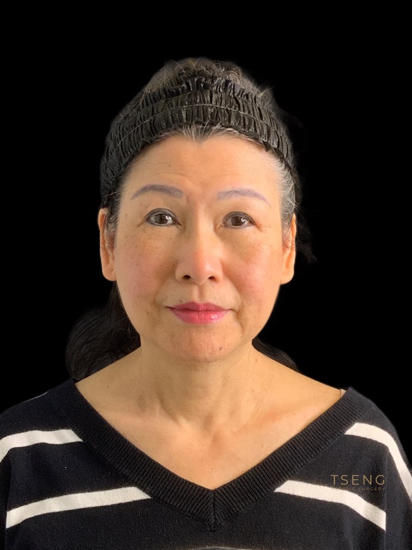 Brow lift Before & After Image