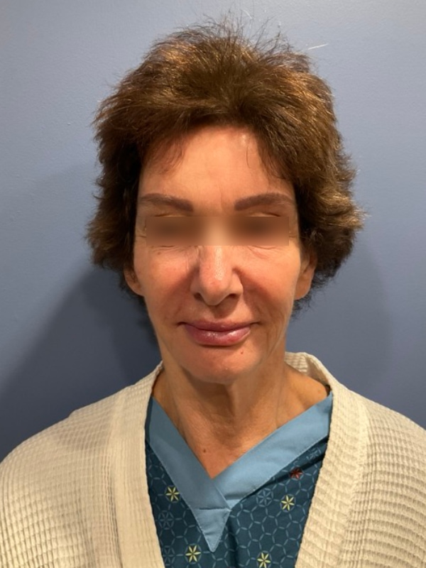 Brow lift Before & After Image