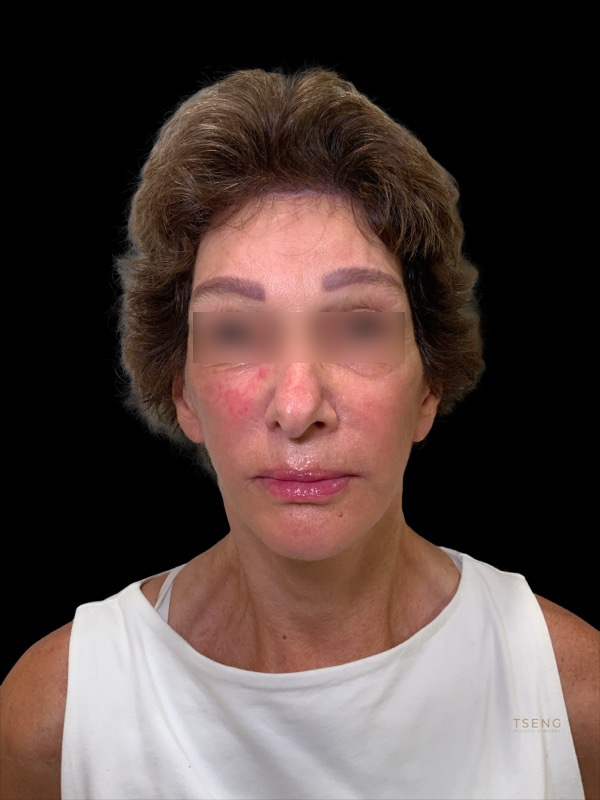 Brow lift Before & After Image
