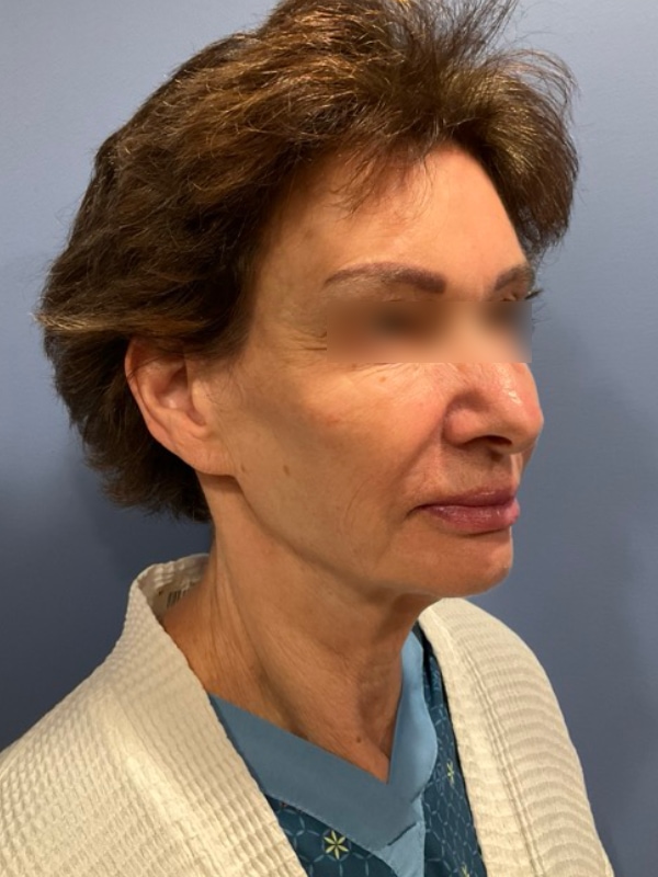 Brow lift Before & After Image