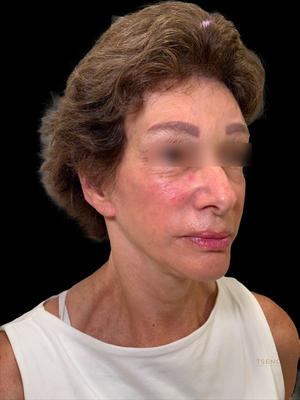 Brow lift Before & After Image