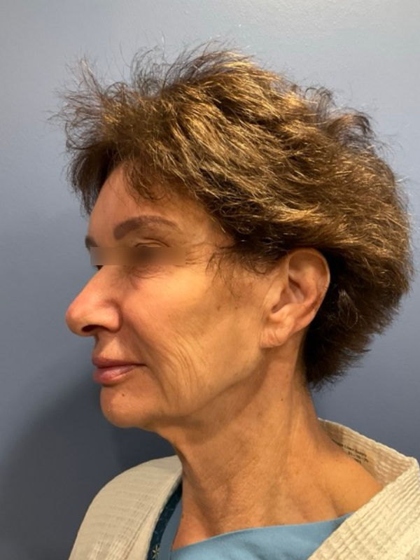 Brow lift Before & After Image