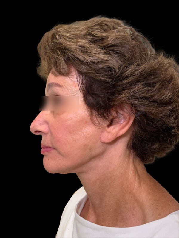 Brow lift Before & After Image