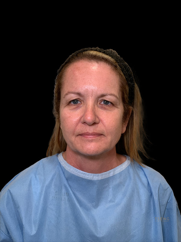 Brow lift Before & After Image