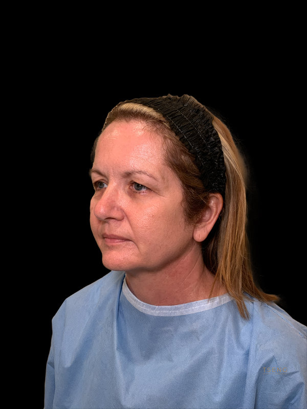 Brow lift Before & After Image